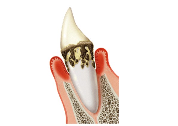 名古屋市守山区の歯医者、もりやまファミリー歯科の歯周病治療
